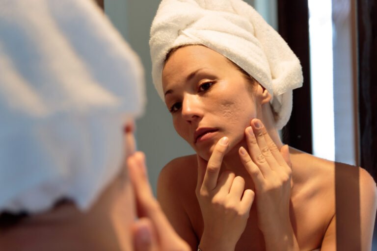 The way to Deal with Zits Naturally