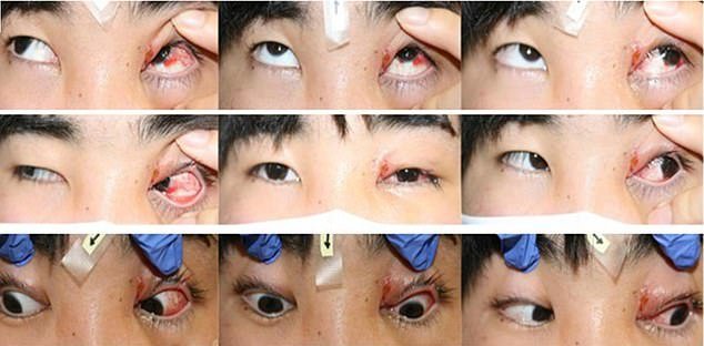 Man, 19, suffers a paralyzed EYEBALL after being bitten on the face by a German shepherd and growing ‘canine tooth syndrome’